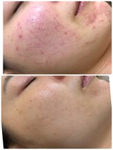 アンジェロ/【ニキビケア】肌育プログラム