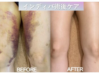 ラディアント(Radiant)/インディバ術後ケア/肌質改善