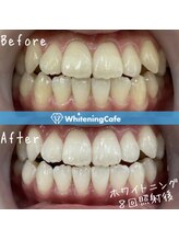 ホワイトニングカフェ 小山店/＊ホワイトニング症例写真＊