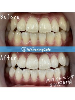 ホワイトニングカフェ 小山店/＊ホワイトニング症例写真＊