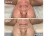 30代から【大人ニキビ×赤み肌改善】〔艶肌、再生ケア〕¥7700→5500