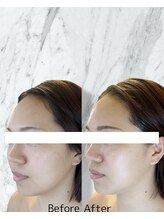 ルミライ(Lumirai)/たるみ改善|毛穴|フェイシャル