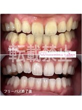 ホワイトニングサロン 福岡博多店/ホワイトニング