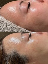 ウルソワン 都島店(/ulu soin)/花粉での肌荒れ改善