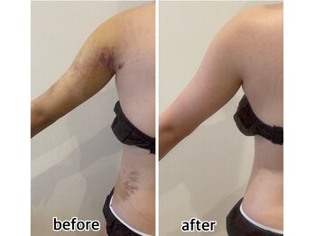 インディバジェム(GEM)/ビフォーアフター