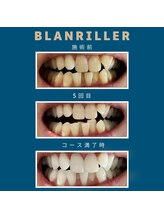 ブランリエ 天王寺阿倍野店(BLANRILLER)/セルフホワイトニング