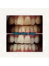 ホワイトニングショップ 奈良香芝店(Whitening shop)/セルフホワイトニング