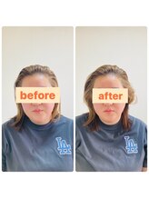 アレス鍼灸整体サロン/美容鍼（フェイスライン）