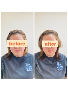 アレス鍼灸整体サロン/美容鍼(フェイスライン)