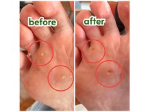 気になっていた足のお悩みを解消！肥厚爪/魚の目/タコ/巻爪/角質