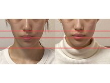 小顔22 ボルティ 赤坂支店(Bolty)/【悩み】面長、顎の長さ