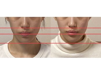 小顔22 ボルティ 赤坂支店(Bolty)/【悩み】面長、顎の長さ