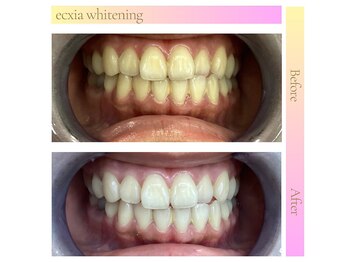 エクシアホワイト 広島袋町店/ホワイトニングビフォーアフター