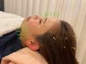 美容鍼　ライト４０分