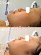 ルノン(Lunon)/毛穴洗浄ハイドロ×ララピール