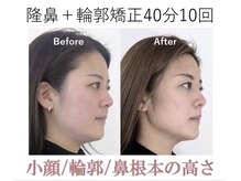 ラプリ 梅田店(Raplit)/隆鼻＋輪郭矯正40分10回