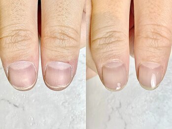 レヴィア(Revia)/深爪ケア 経過