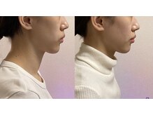 小顔22 ボルティ 赤坂支店(Bolty)/【悩み】面長、顎の長さ