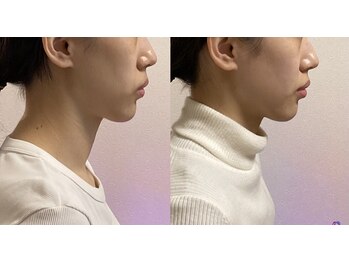 小顔22 ボルティ 赤坂支店(Bolty)/【悩み】面長、顎の長さ