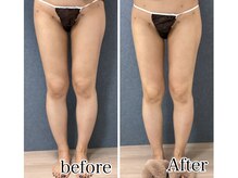 ビーホープ(B.hope)/30代モニター様1回目の変化