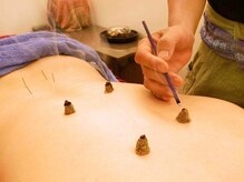 やさしい鍼と、あたたかいお灸で身体の巡りを整えます