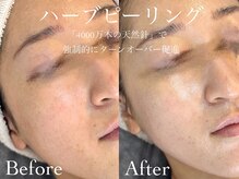 ルチーレ(Lucire)/ハーブピーリング　1回目