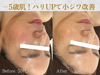 ぷるる 練馬 江古田/50代 ララ+ゲルマスク導入