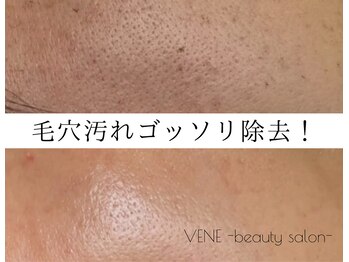 ウェヌ(VENE)の写真/【取り扱い希少!!】オーガニック成分マツヤニwaxで気になる毛穴のお悩みを改善♪ワントーン明るいお肌へ★