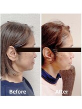 小顔22 ボルティ 赤坂支店(Bolty)/50代：施術10回