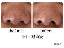 ニコリ(nicori)/【毛穴ケア】beforeとafter