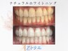 初回限定【プレミアムホワイトニング】30分照射