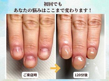 ブルームーンネイルズ(BLOOMOON.nails)の写真/【深爪矯正特化サロン】人に見せるのが嫌だった指先に☆何度もやめようとしてきた深爪・爪かみのお悩みへ