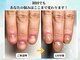 ブルームーンネイルズ(BLOOMOON.nails)の写真/【深爪矯正特化サロン】人に見せるのが嫌だった指先に☆何度もやめようとしてきた深爪・爪かみのお悩みへ