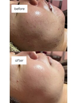 薫風/ハーブクリームピーリング/30代