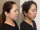 ビクシー(Bixie)の写真/【小顔になりたい方必見!】骨の歪みから整え、脂肪燃焼&たるみ改善を叶えるフル小顔プラン◎