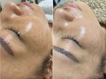 小顔はもちろんお肌も美しく整えます◎