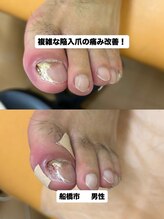 巻き爪じゅん 船橋店/巻き爪と陥入爪の痛みを和らげる