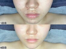 アンドミー 池袋(&me)/剥離・ダウンタイム無し◎