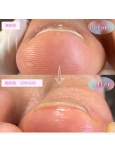 まき爪晴れる/痛みは早く取れます