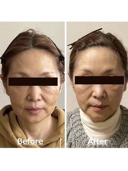 小顔22 ボルティ 赤坂支店(Bolty)/60代：施術３回