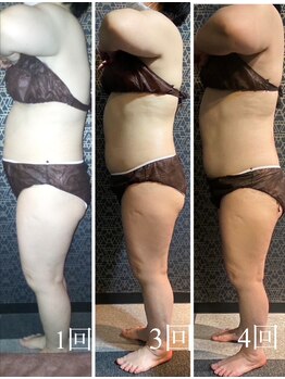 ラクラク(rakuraku)/全身痩身【腹部、脚】1~4回目