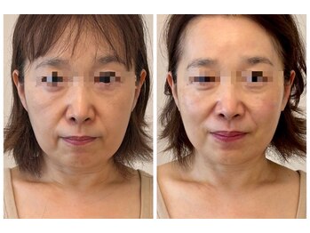 メディカルエース(MedicalAce)/若々しい印象へ！ならハイサーマ