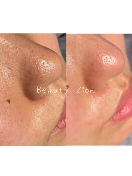 ビューティーザイオン(Beauty zion)/毛穴洗浄の魅力