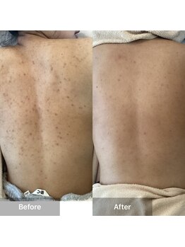 モカ 天王寺店(MOKA)/剥離3回　毛穴　背中ニキビケア