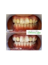 ホワイトニングサロン 名古屋駅店/【ホワイトニング施術例】