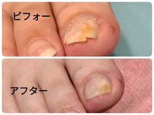 フットケアサロン ラビフット(Rabbi foot)/割れ爪は早めのケア