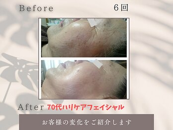 トータルビューティー雅/70代お客様肌若々しくシワに注目