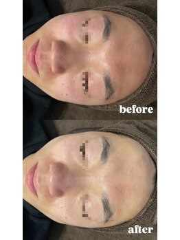 エクラ(ECLAT)/ハイドロで毛穴洗浄を