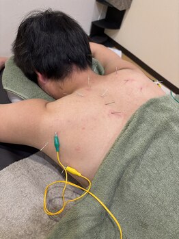 晴々の写真/全身マッサージ、鍼灸でのケアで首肩こりスッキリ！頭を含めた全身の凝りをほぐしてリフレッシュ◎