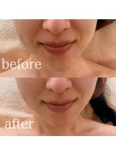 ブランシェ 野々市店 × 椿/シワ・たるみケア『30代お客様』